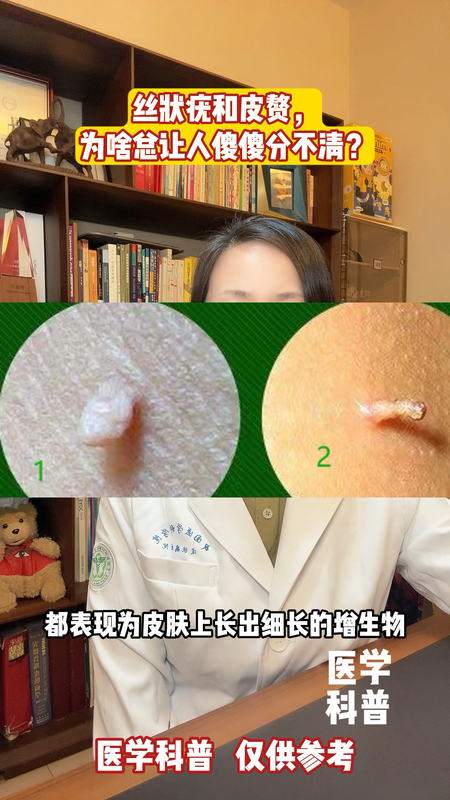 丝状疣和皮赘为啥总让人分不清？
