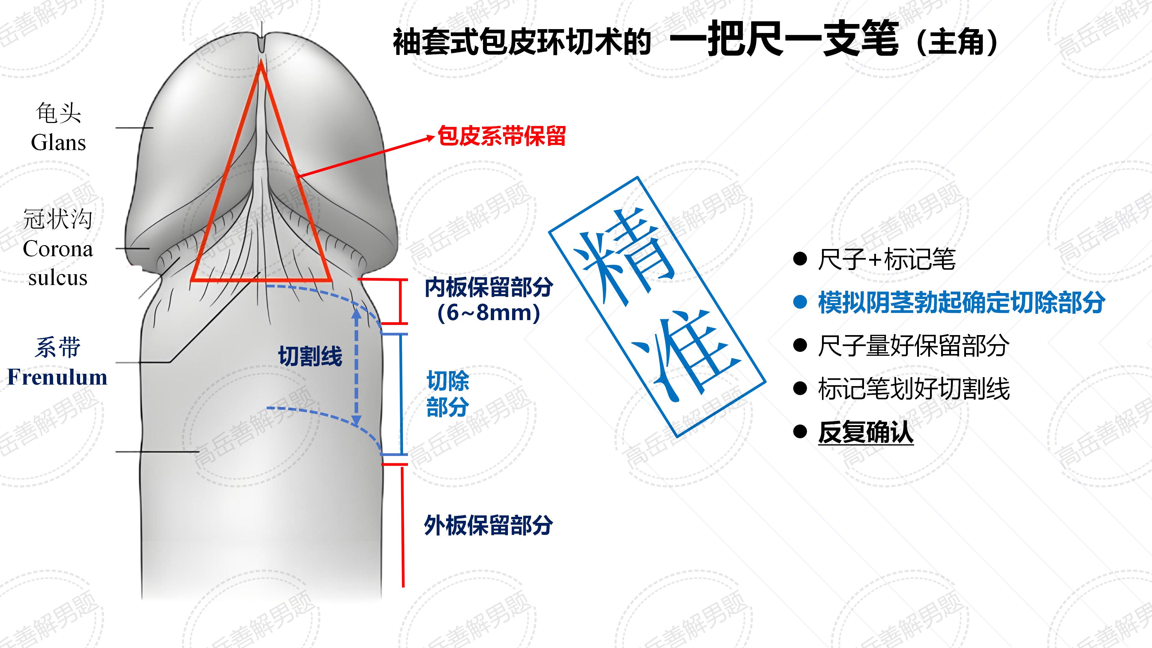 袖套式包皮环切术:我费时费力,你美容增粗只剥皮
