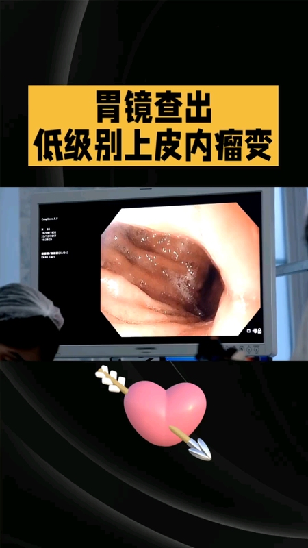 胃镜查出“低级别上皮内瘤变”，该咋办？