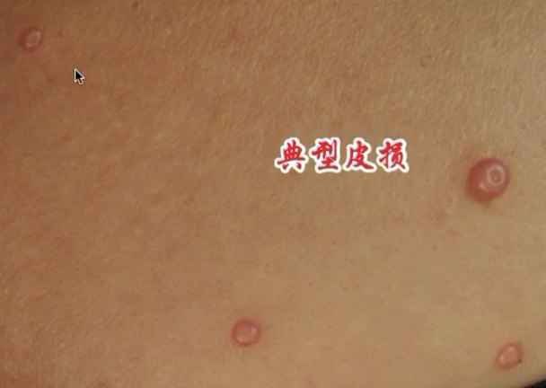 传染性软疣到底长啥样？