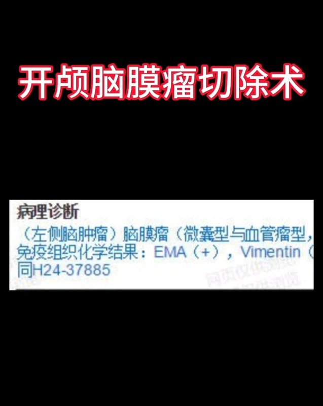 开颅脑膜瘤切除术