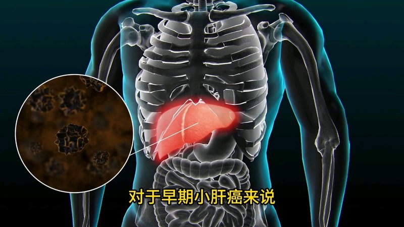 医生观点：微波消融和射频消融有些什么区别和共同的特点？