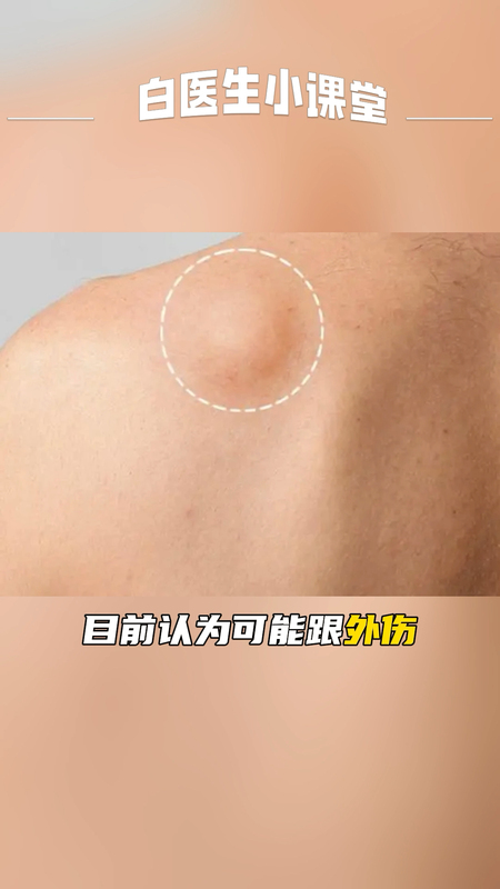什么是纤维瘤？