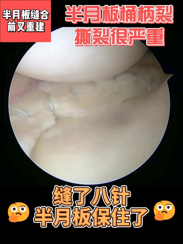 缝了八针，内侧半月板保住了！