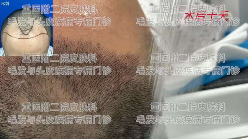 毛发移植术后10天