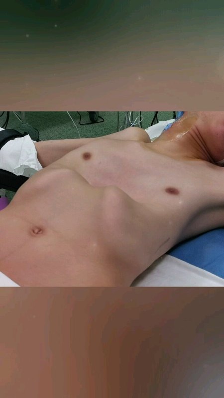 无处就医的极重度胸廓畸形患者重获新生！漏斗胸、胸壁畸形；本是地狱难度的手术，却被驾轻就熟地顺利完成。