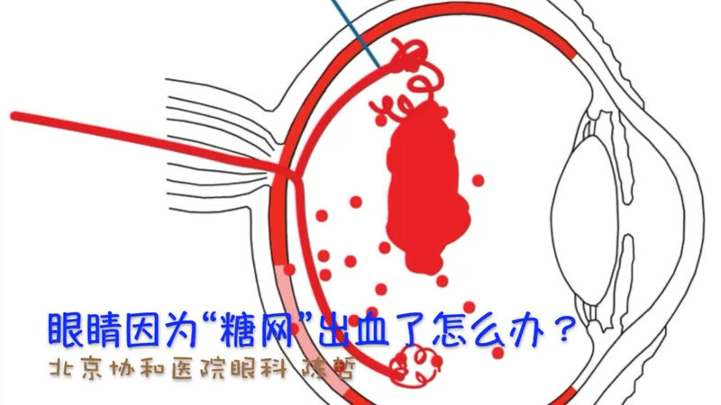 “糖尿病视网膜病变”大量出血时的玻切手术，是什么样儿的？