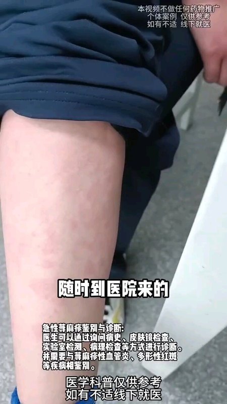 得了急性荨麻疹怎么办?