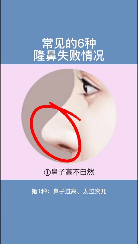 常见的6种鼻整形失败情况，快看看你中招了吗？