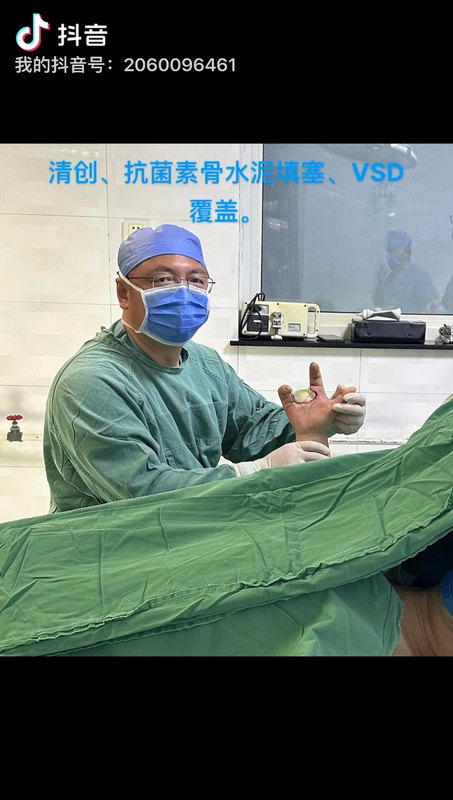 手外伤腹部皮瓣术后感染，清创后，游离股前外侧皮瓣修复。