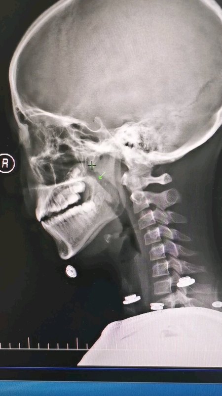 腺样体术后， 会复发吗？