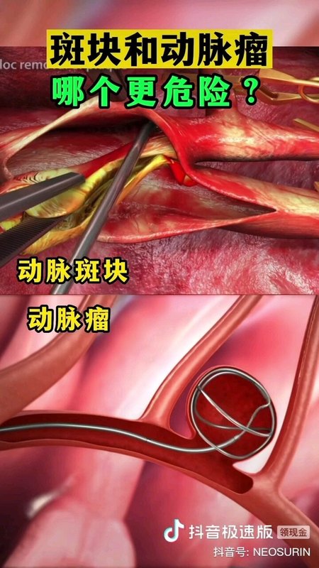 颈动脉剥脱手术与动脉瘤栓塞手术！