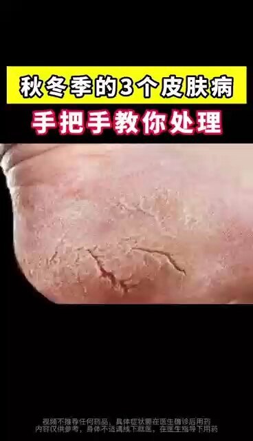 秋冬季常见的3个皮肤病，手把手教你处理