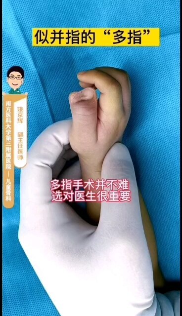 这不是并指，这是多指！ 指甲相邻的多指难点在于生甲基质的处理上，也就是大家理解的树根。