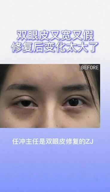 双眼皮“又宽又假”
                    修复后变化