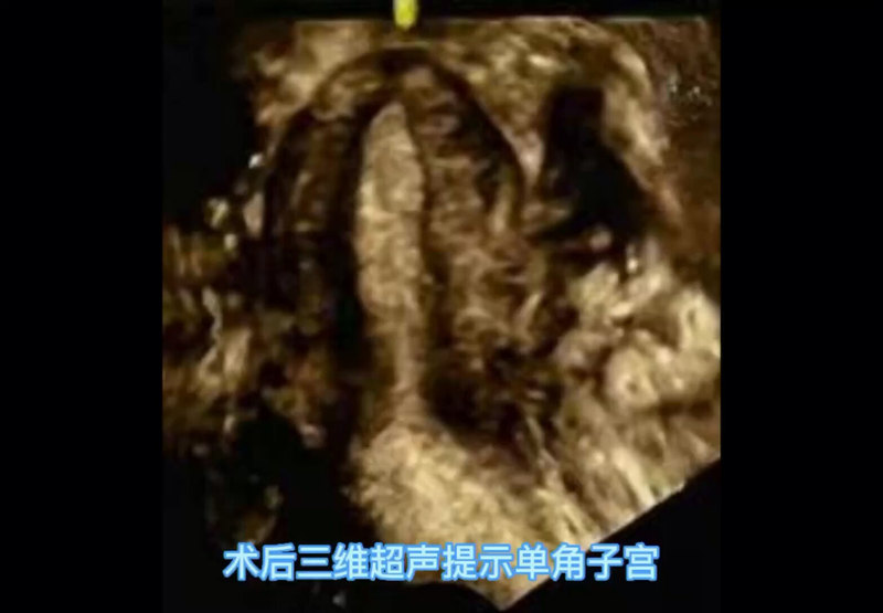 单角子宫