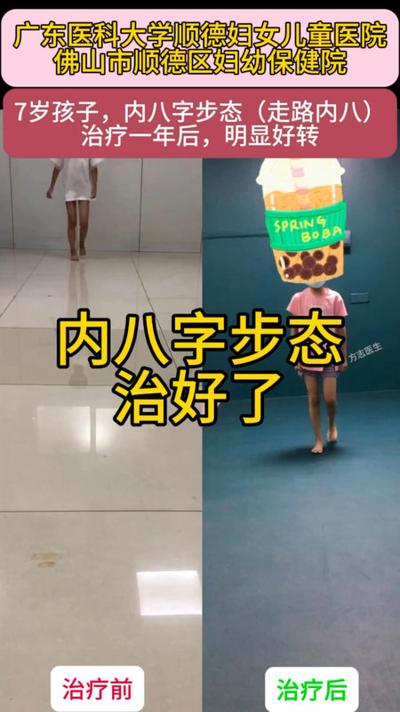 7岁孩子，内八字步态（走路内八），治疗一年后，明显好转。