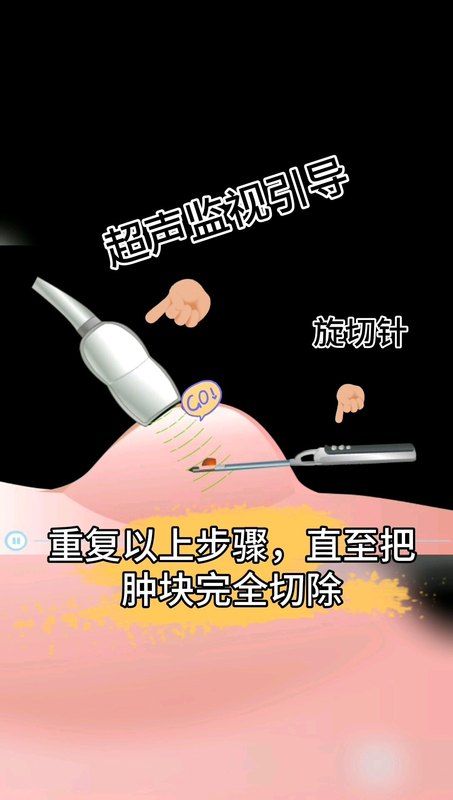 超声引导下乳腺结节微创旋切术动画