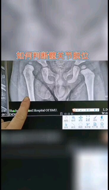 如何判断髋关节脱位？儿童髋关节脱位发现的越早，治疗越简单，恢复效果越好！