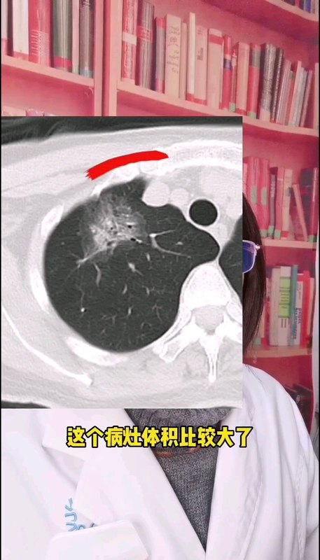 肺癌和肺结核的鉴别
