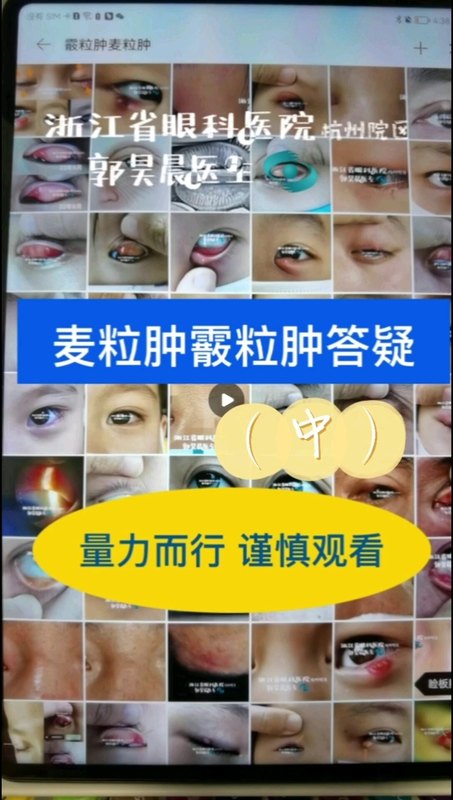 霰粒肿长什么样？