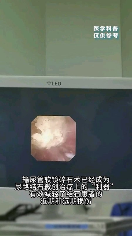 软镜下碎石