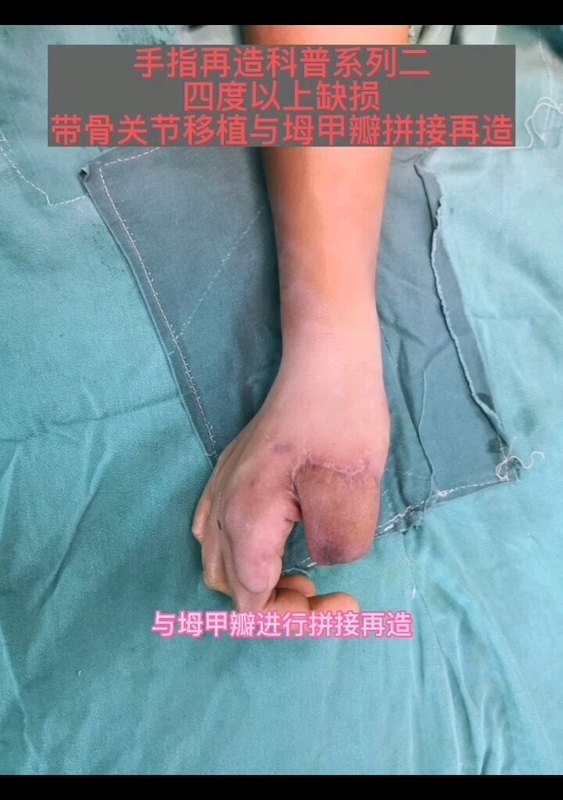 不牺牲足址移植手指再造科普系列二