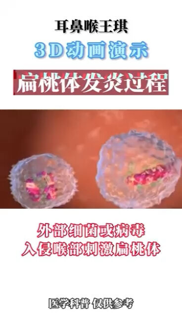 慢性扁桃体炎发病过程
