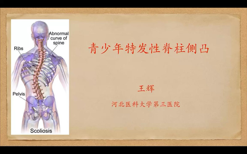青少年特发性侧弯