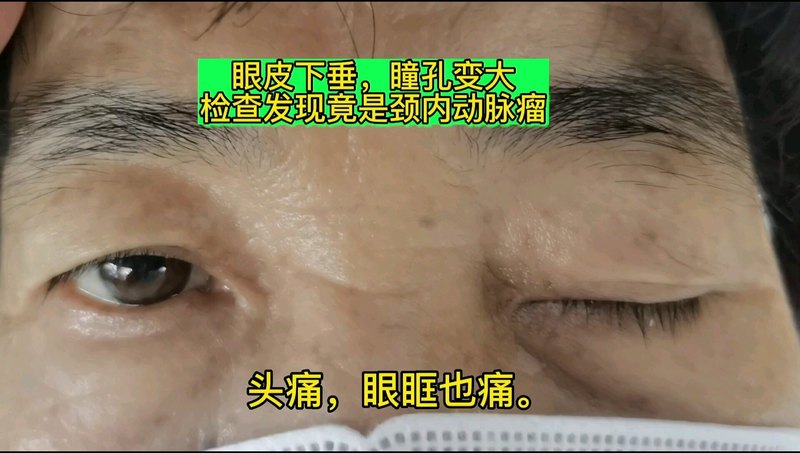 眼皮下垂、瞳孔变大、眼球运动受限，在我检查发现竟是颈内动脉瘤。颈动脉瘤属于一种非常严重的疾病。