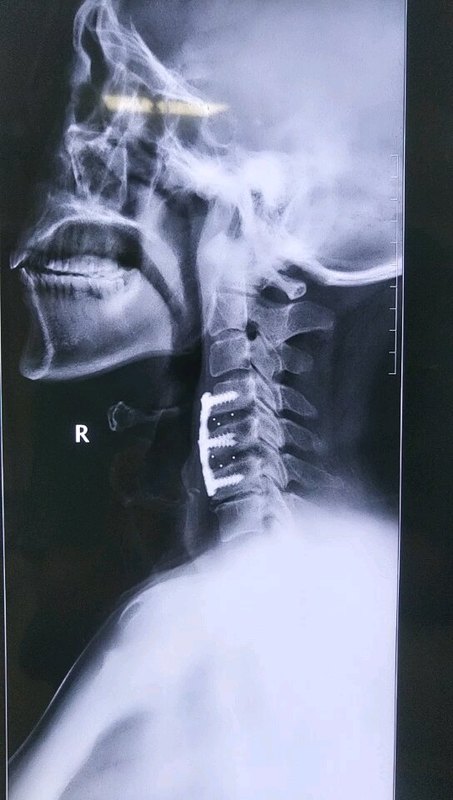 学术问题：融合固定后的间隙是否还会出现继发狭窄的症状？