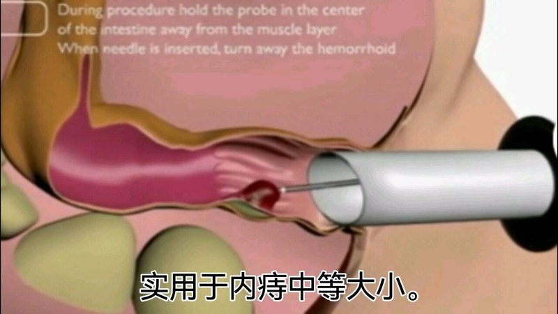 痔疮的微创，无痛手术。内痔硬化剂注射，内痔套扎术