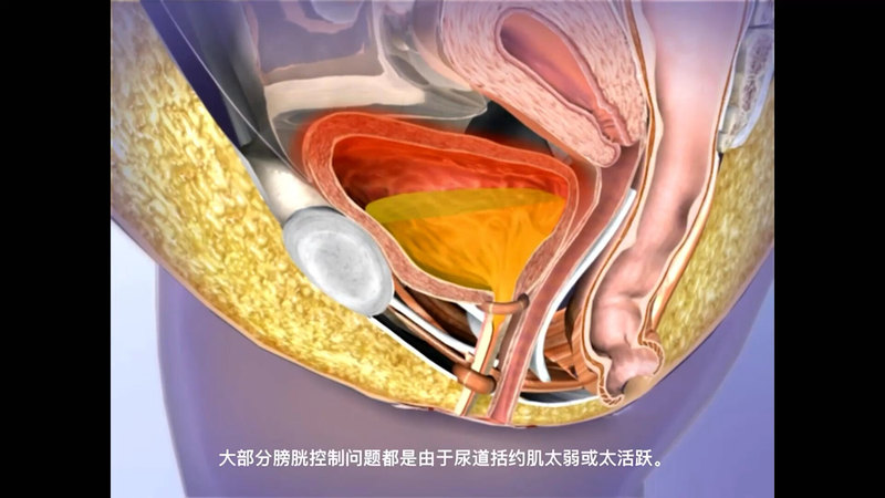 动画演示：尿道括约肌受损引起尿失禁的表现