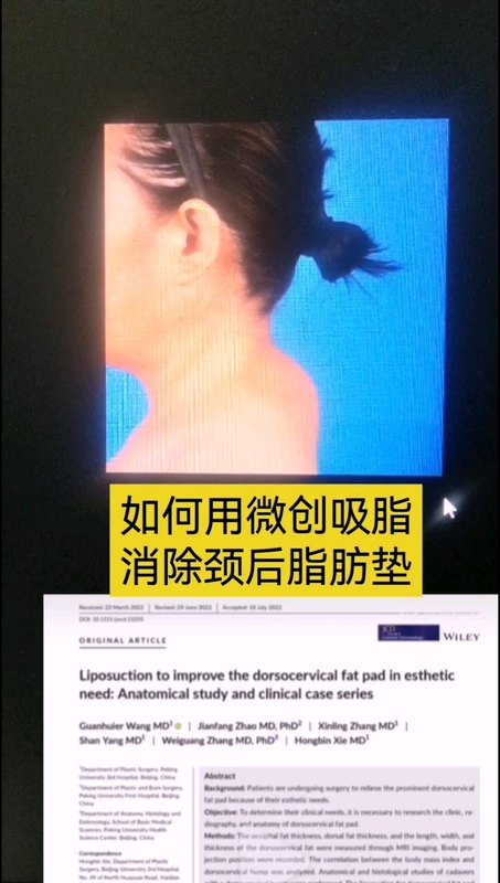 微创吸脂消除颈后脂肪垫
