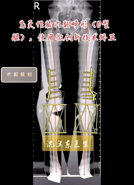 微创新技术治疗先天性膝内翻畸形，世界上最先进的骨外固定支架-泰勒六轴空间支架