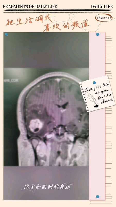 健康体检刚刚结束2个月，头疼检查发现脑内胶质瘤，全切肿瘤后 症状消失…