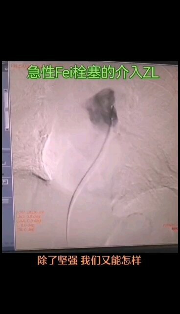 号称猝死之王的肺栓塞，可以介入治疗啦！