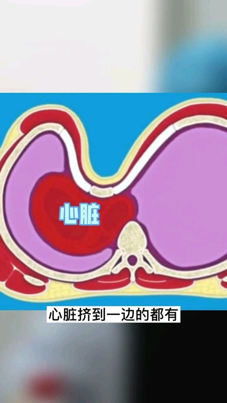 20多岁小伙子的漏斗胸