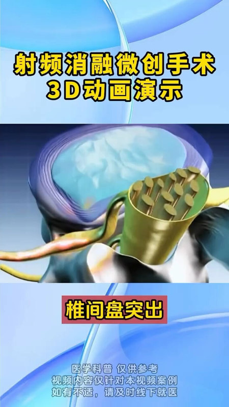腰椎间盘突出射频消融技术
