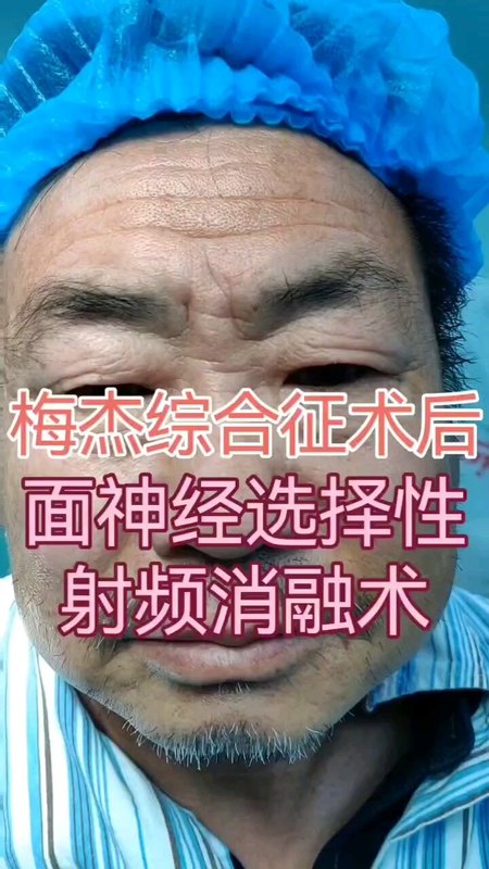 改良面神经选择性射频消融术治疗梅杰综合征（图像经患者同意发布）