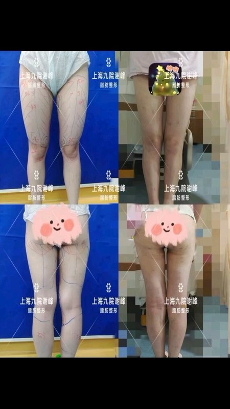 就是这“家”抽脂做的超级棒哦