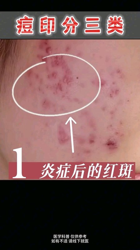 痘坑痘印怎么办？??