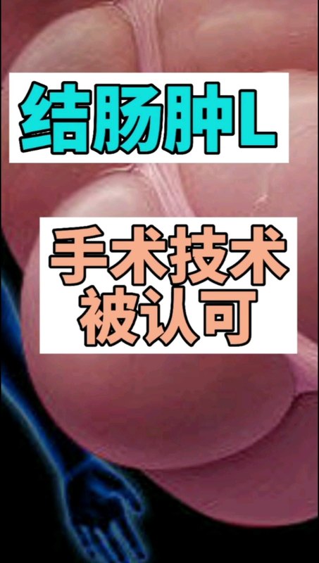 结肠肿瘤手术技术得到认可