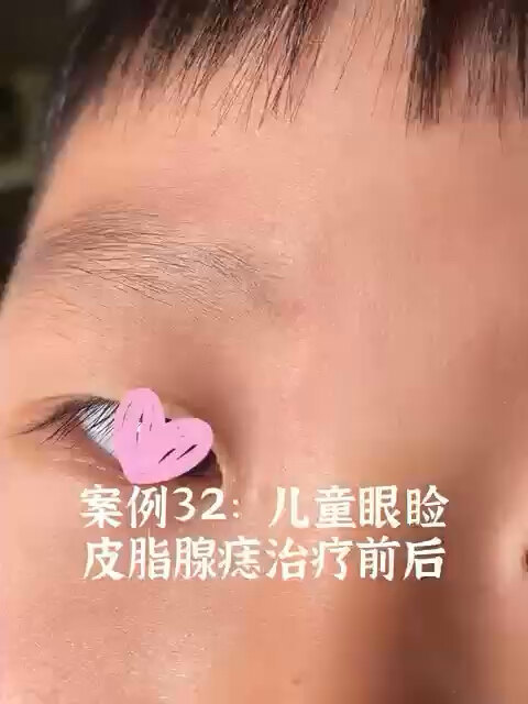 皮脂腺痣在眉毛边上鼻子旁边的手术案例