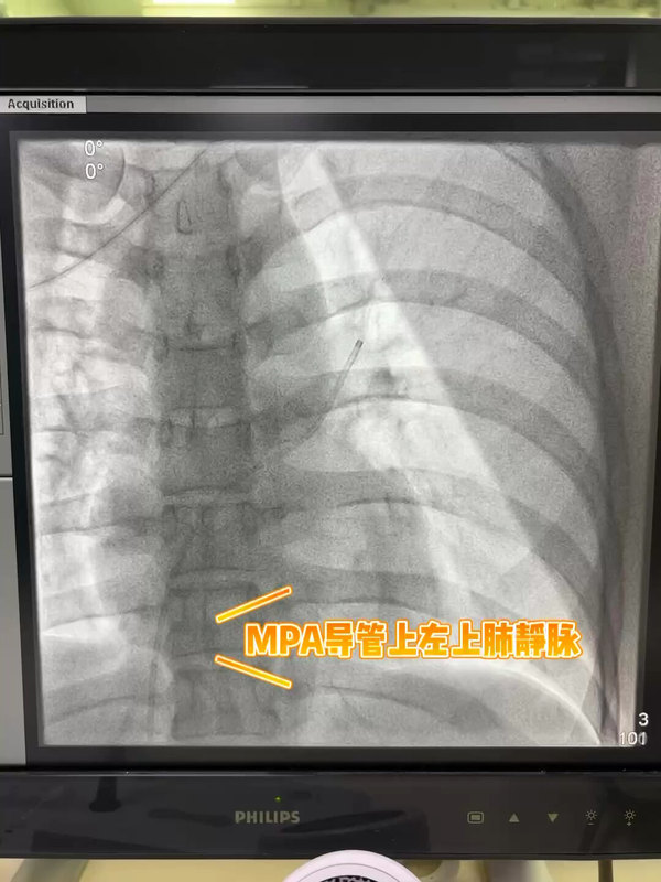 经皮卵圆孔未闭封堵术