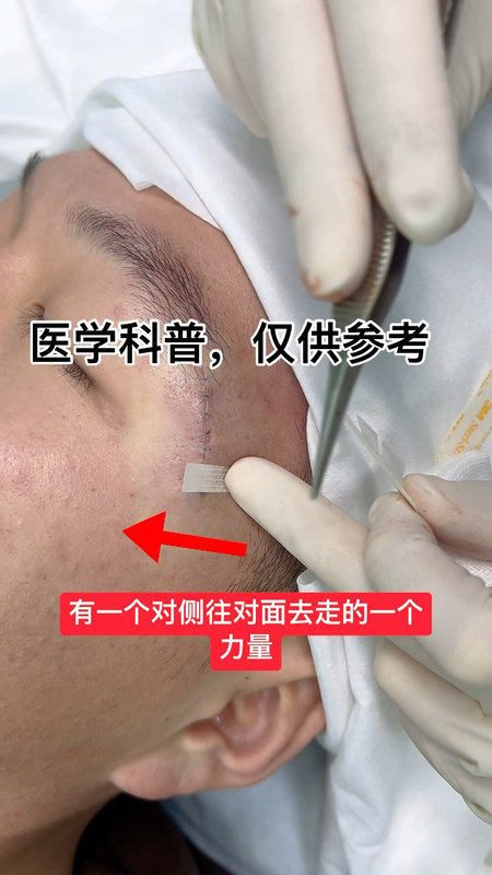 美容缝合后，减张贴怎么用呢？快来学学吧！