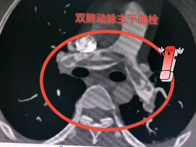 警惕沉默的杀手——
                    下肢深静脉血栓形成及肺动脉栓塞