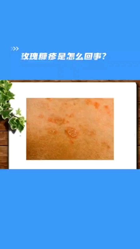 玫瑰糠疹是怎么回事？