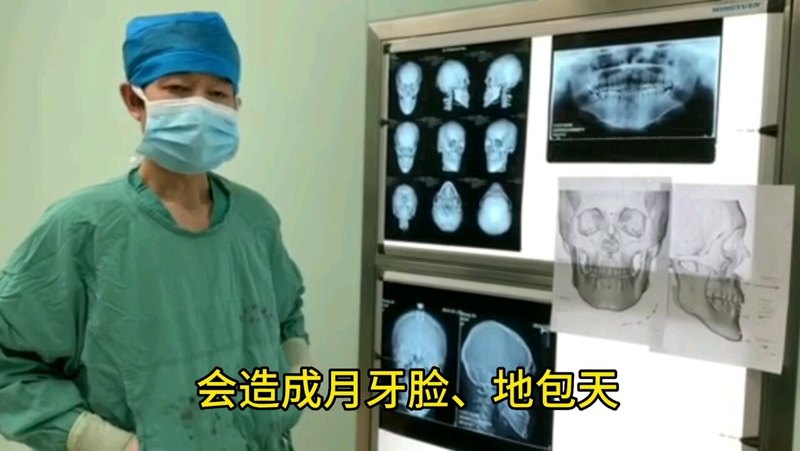 上颌后缩、下颌前突—
                    双颌正颌整形手术