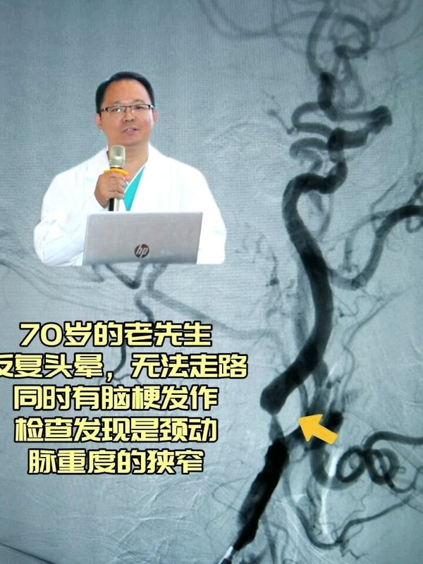 脑动脉狭窄是脑梗塞的重要原因